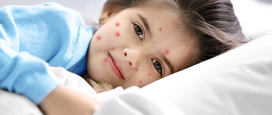 enfant contaminé par la varicelle